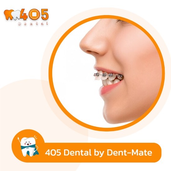 วิธีป้องกันปัญหาขากรรไกรหลังการจัดฟัน - คลินิกทันตกรรม405 เด็นทัล วิธีป้องกันปัญหาขากรรไกรหลังการจัดฟัน - คลินิกทันตกรรม405 เด็นทัล